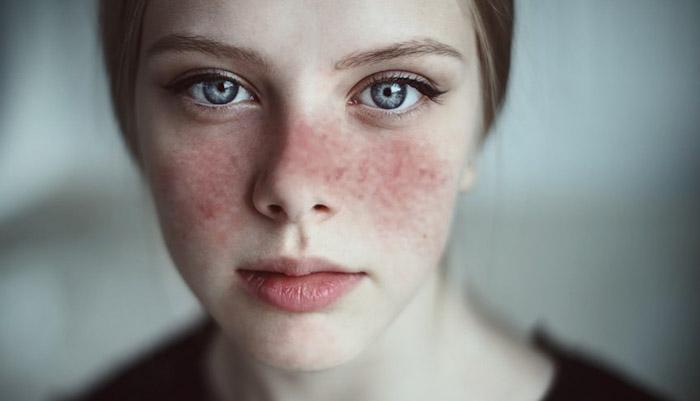عوامل قرمزی پوست صورت و راه های درمان | چرا پوست صورت قرمز می شود