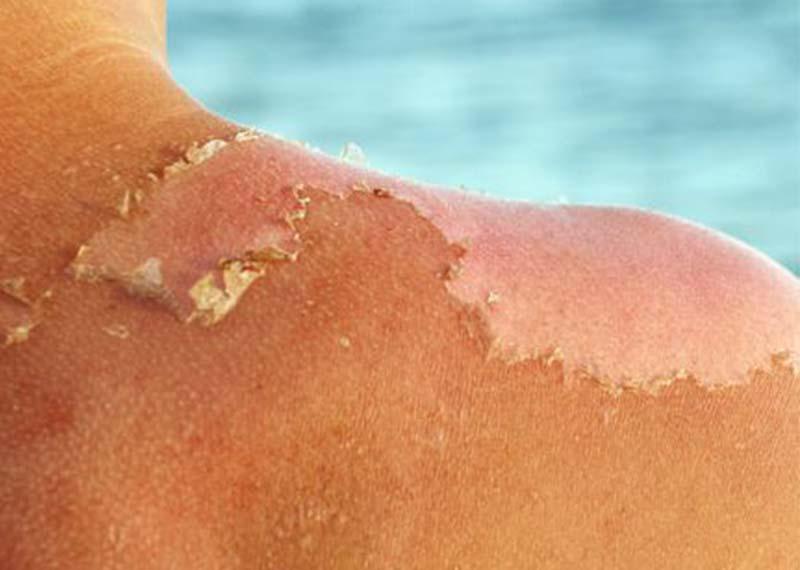عوارض برنزه کردن پوست در معرض آفتاب 