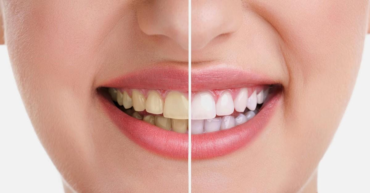 با این روش سفیدترین دندان ها را داشته باشید + جزئیات