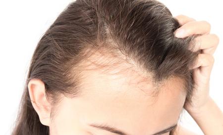 روش هایی مهم برای کاهش ریزش مو