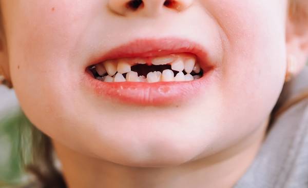 دندان کودکان